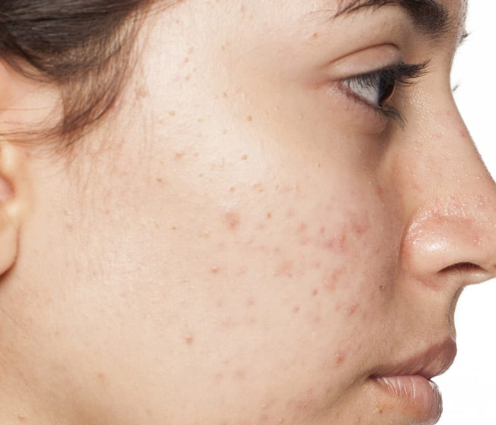 Dermatologist-Recommended Skincare Routine for Your 20s