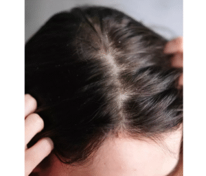 Shampoo for Dry Scalp and Oily Hair