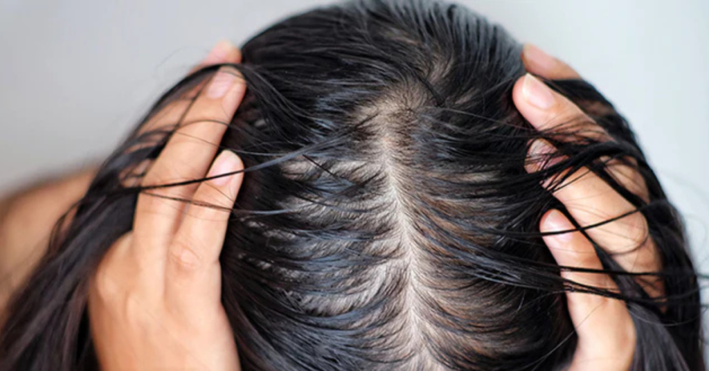 Oily Scalp Oily Scalp